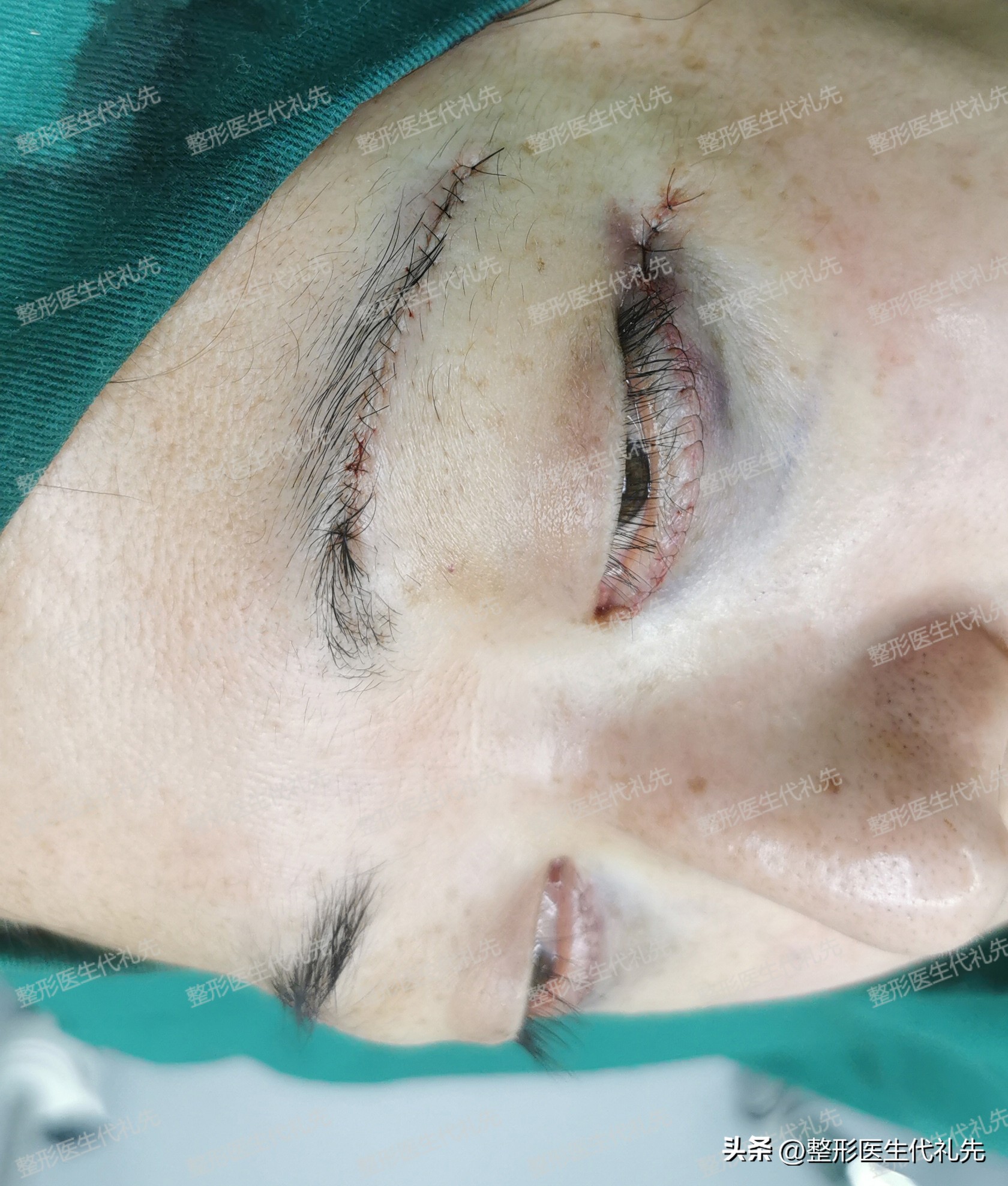 眼袋手术后出现皱纹和凹陷怎么办,祛眼袋手术后凹陷多久恢复好