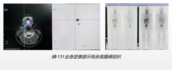 警惕甲状腺癌的高发趋势,医生谈甲状腺癌术后复发或转移