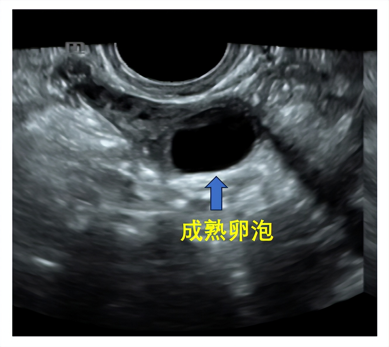 助您好孕——B超监测排卵不可不知道的细节