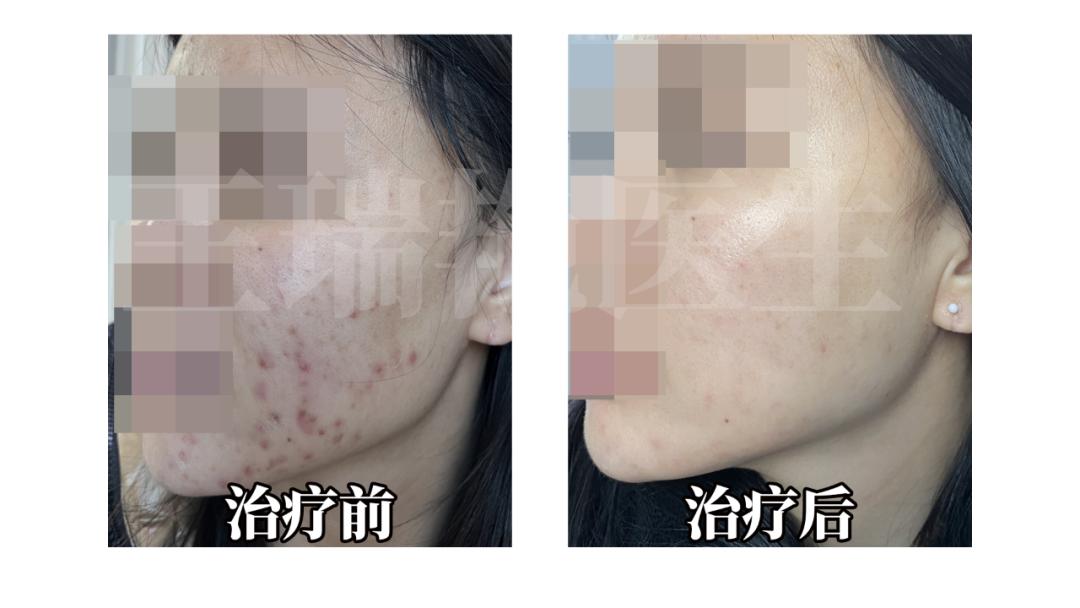 祛痘心得,中年女性祛痘护肤品