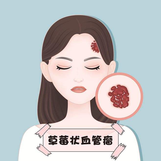 血管瘤胎记微创手术一般要多少钱,胎记与血管瘤的区别