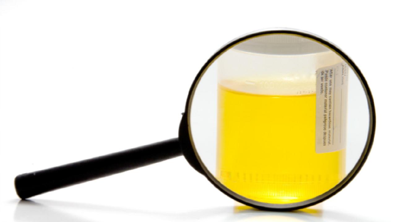 尿液中有大量泡沫是怎么回事,尿液里有不少沉淀物是有病了么