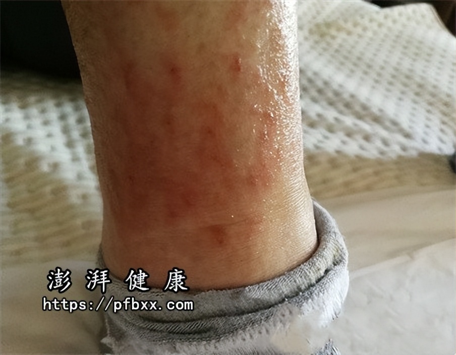 腿上有湿疹痒痒的很怎么治,脚小腿湿疹痒痒的吃什么药好