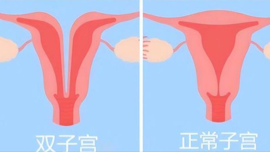 女子检查出两个子宫后续,29岁女检查出双子宫
