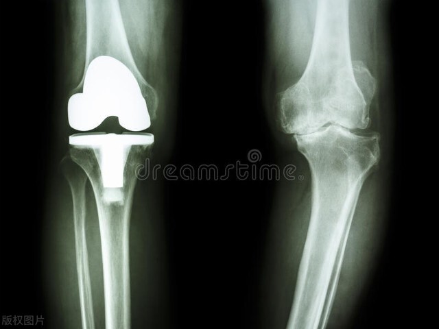 人工膝关节置换手术后，一个月时间里度日如年