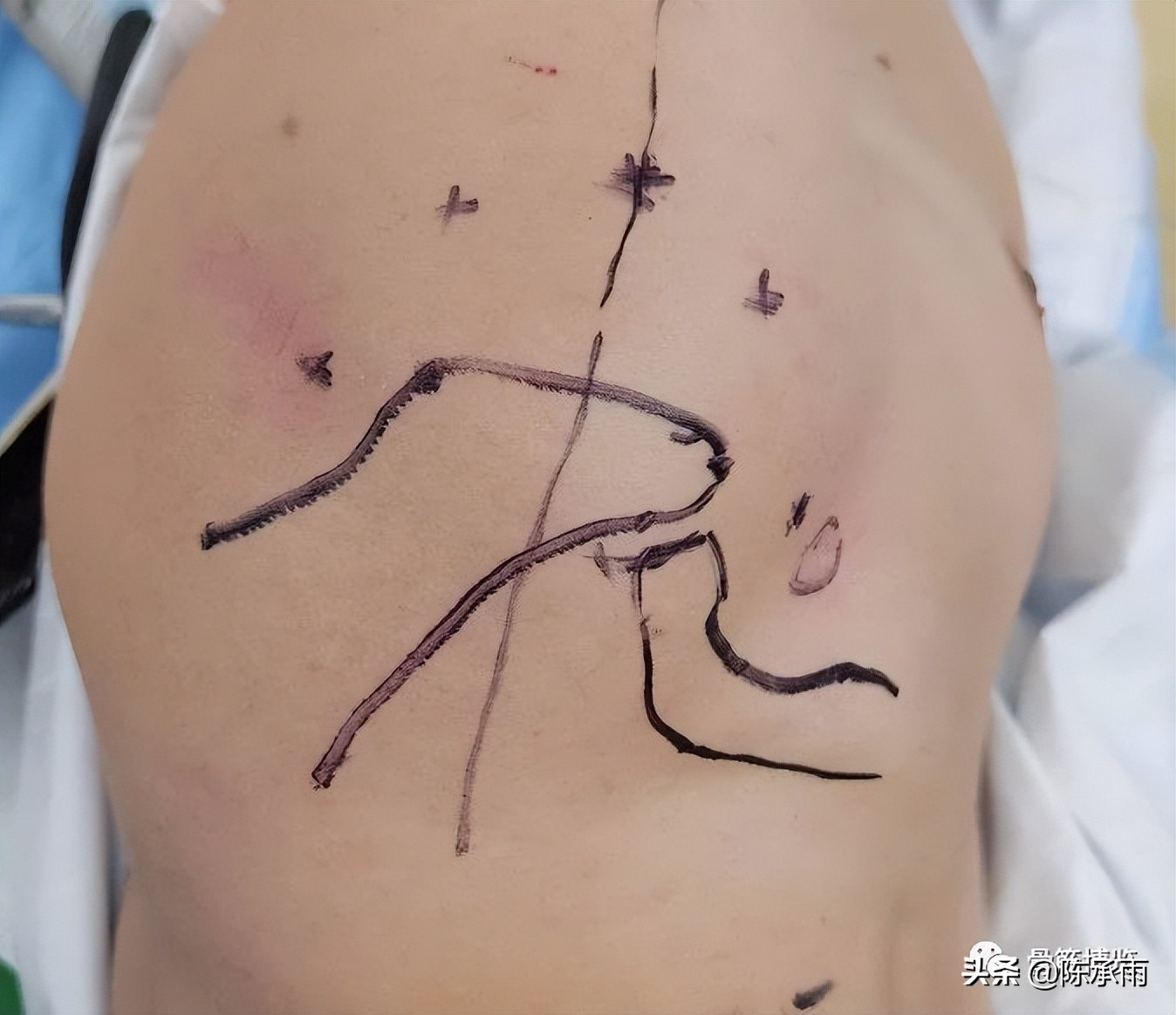 肩关节镜手术后病人的真实感受,肩关节镜手术指征