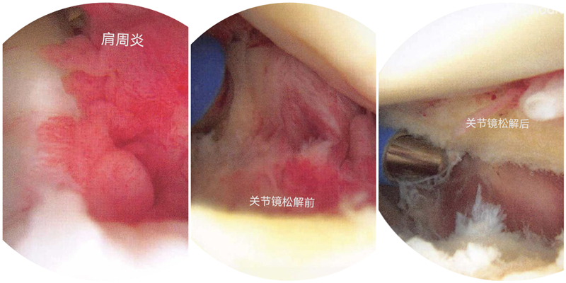秦皇岛军工医院运动医学门诊医生带您了解“肩周炎”