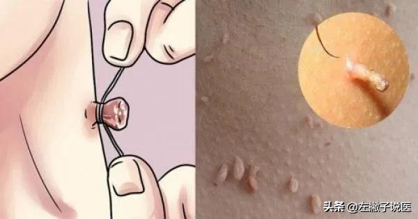 脖子上的“小肉球”是怎么一回事？可以用手抠掉吗？告诉你答案