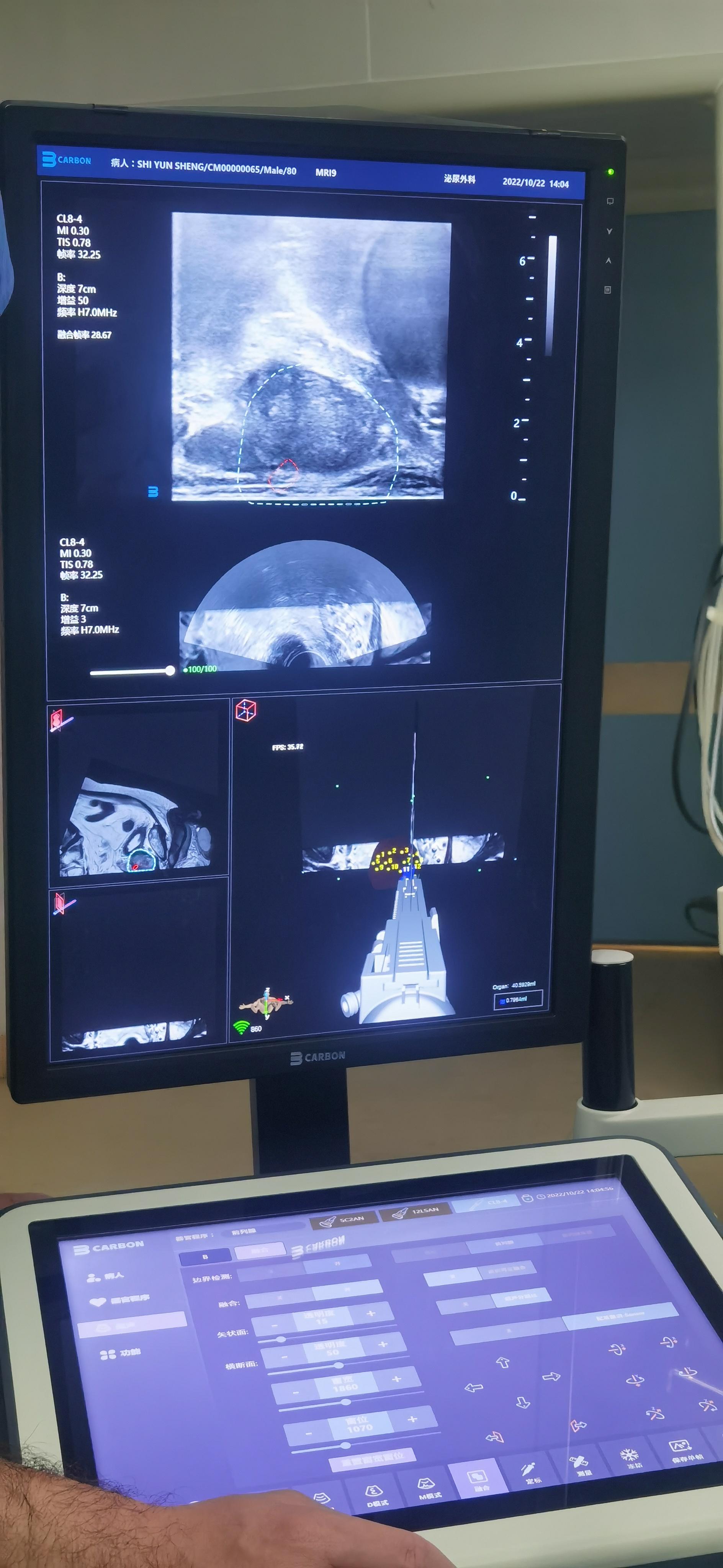 湖南湘雅医院祖雄兵预约,长沙湘雅附一医院祖雄兵