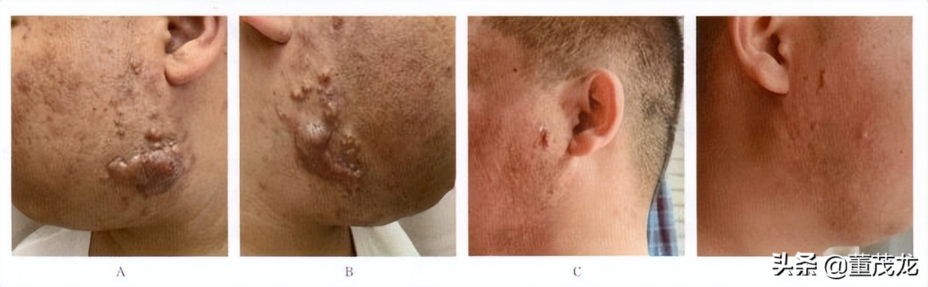 董茂龙说医:瘢痕的放射治疗