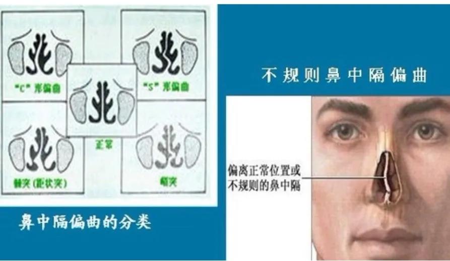 鼻出血介入治疗,鼻出血快速止血