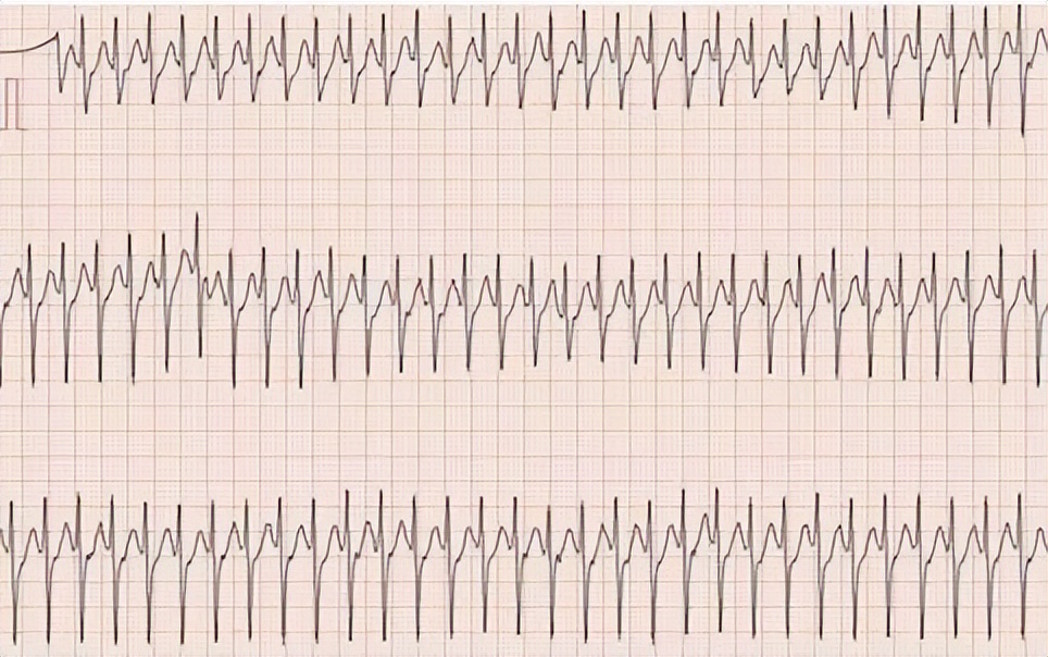 心脏心律不齐是什么原因引起的,心律不齐是心脏病吗吃什么药治