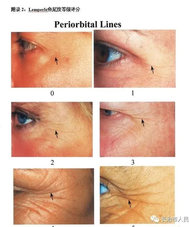 长治市人民医院：您想解决皱纹的烦恼吗？来试试吧！免费的哦