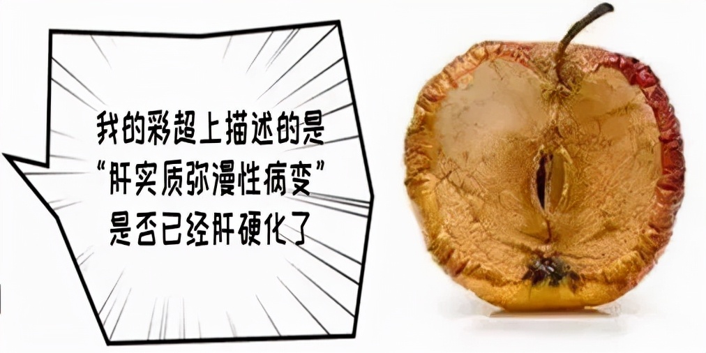 肝硬化性结节和弥漫性肝癌的区别,肝硬化肝内弥漫性占位