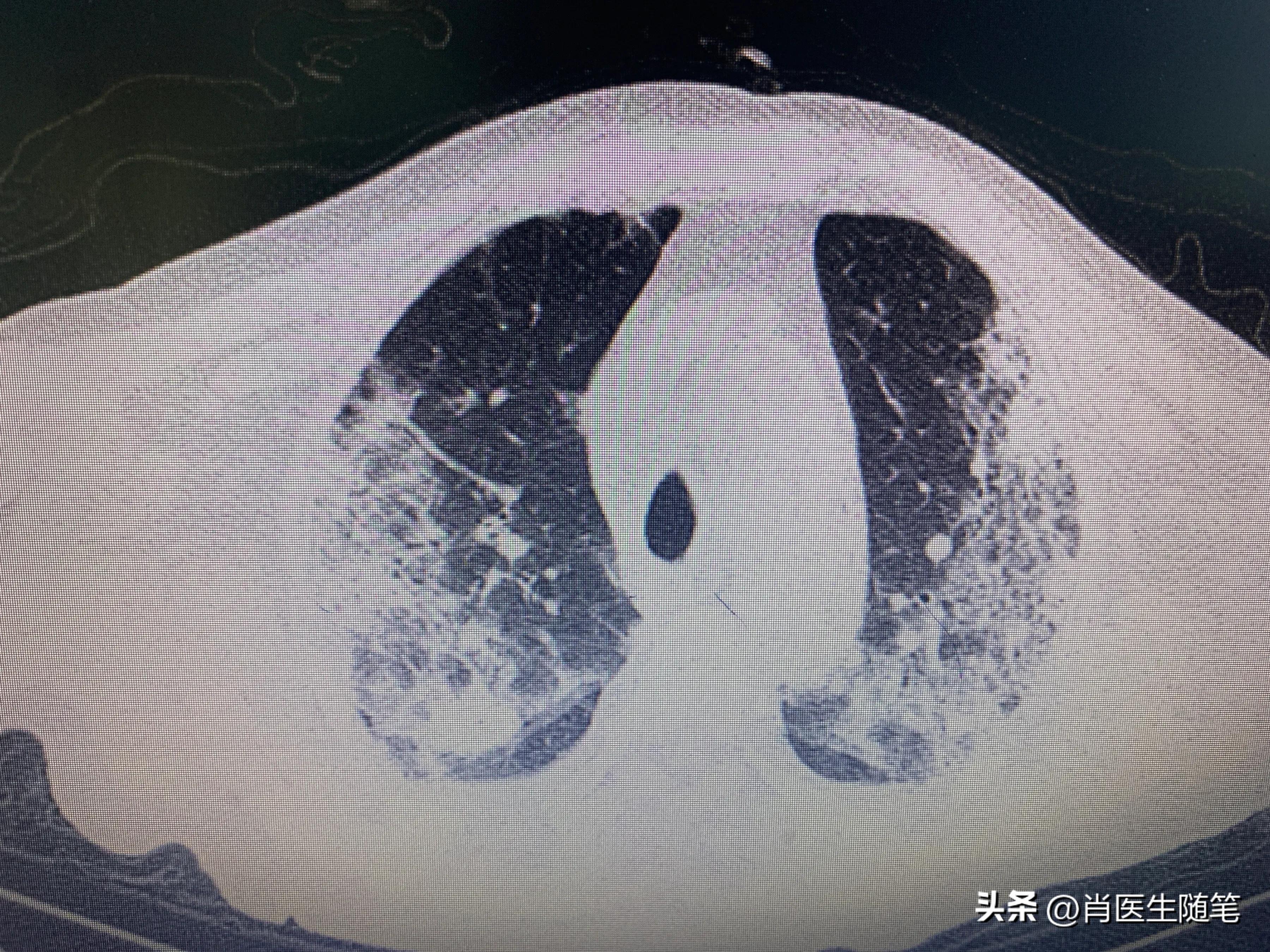 84岁老人白肺治好了,86岁老人得了大白肺还有救吗