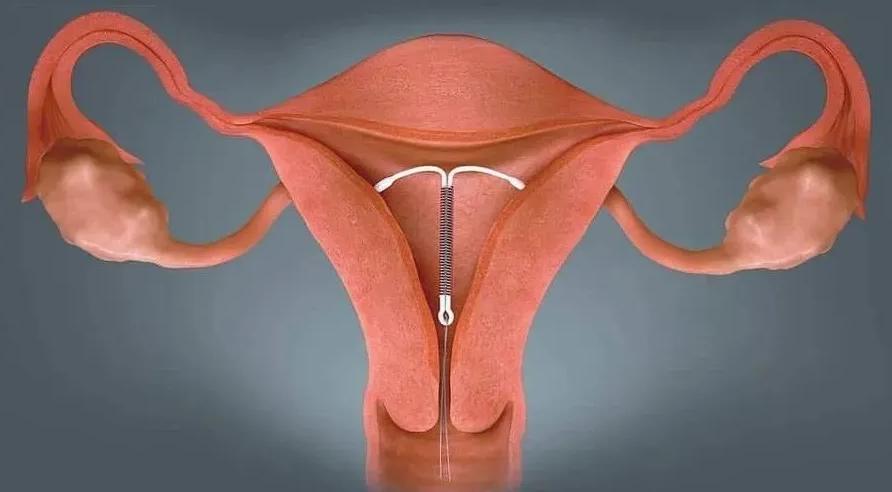 女性年龄大了节育环一定要取掉吗,女性节育环长时间不取的危害