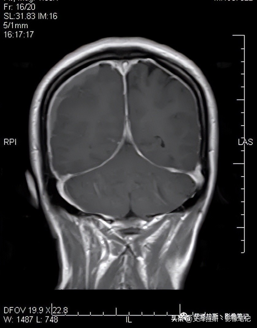 中枢性低通气综合征,中枢性低通气综合征可以治愈吗