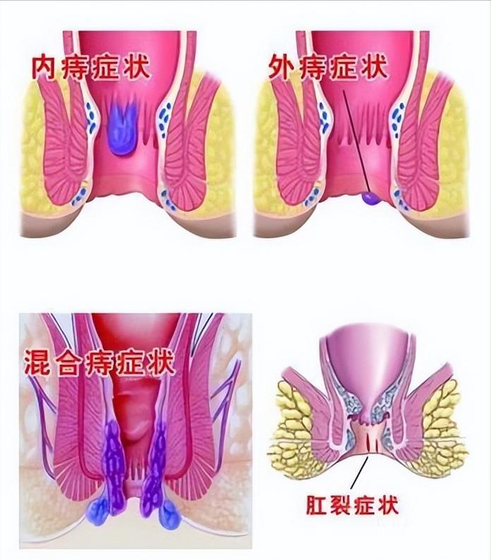 新龙甘消炎膏对痔术后疼痛及水肿的相关效性随机对照临床试验
