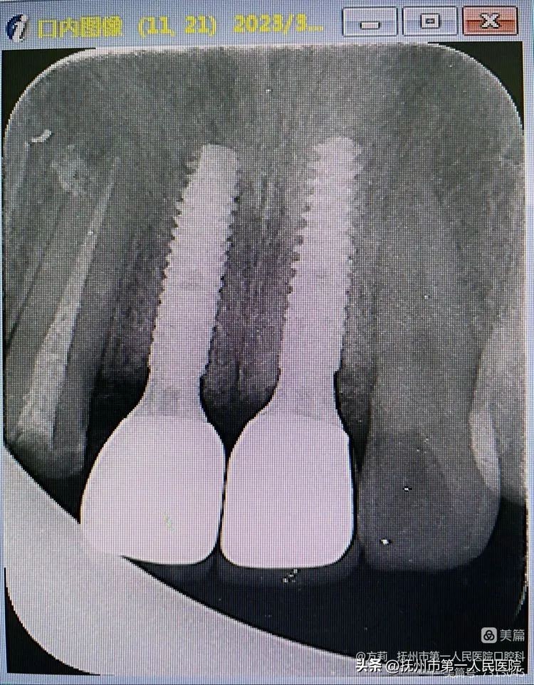 种植牙可修复多种牙齿缺失类型,学科建设口腔科