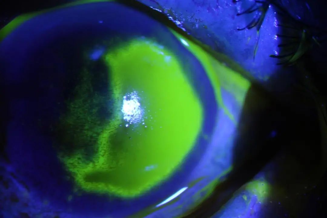 染发后，她“泪流满面”地走进眼科诊室