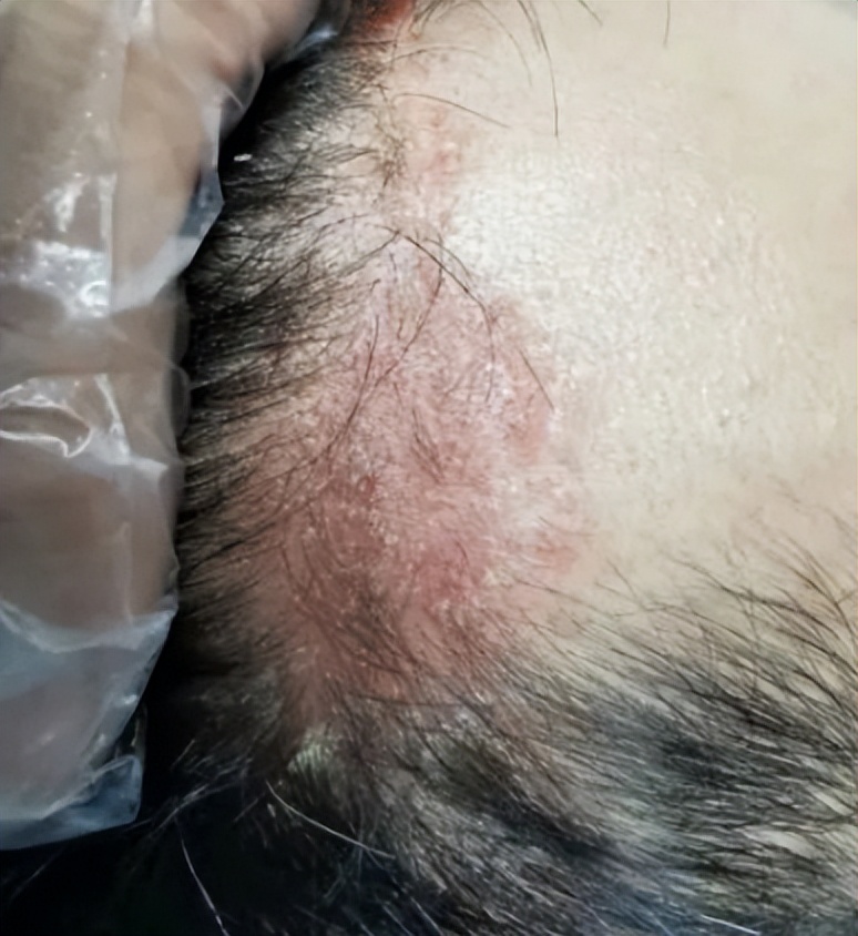 头皮脂溢性皮炎头皮红有皮屑,脂溢性头皮皮炎需要怎么治疗