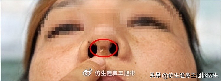 假体隆鼻的危害和后遗症,隆鼻整形麻醉你能坚持多长时间