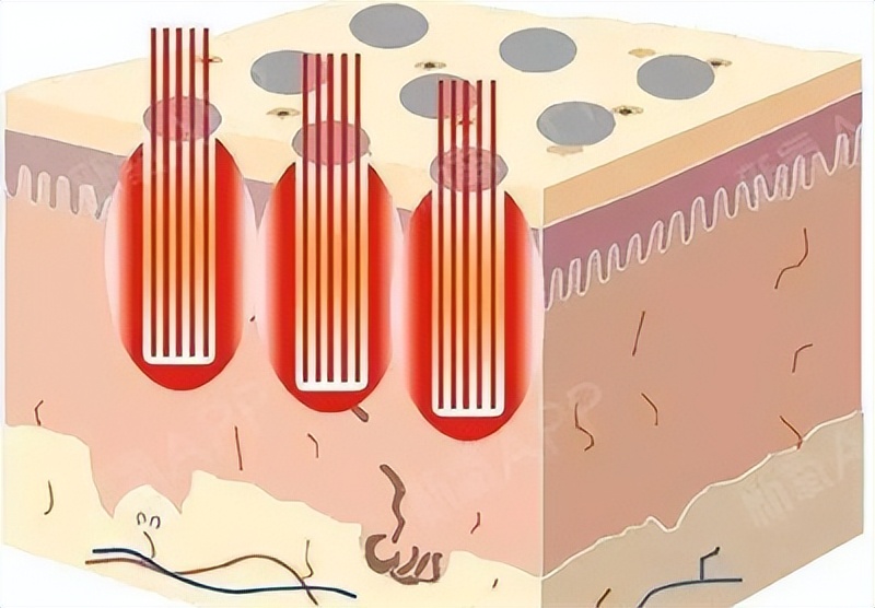雄秃是哪里出了问题,雄秃真的无解吗
