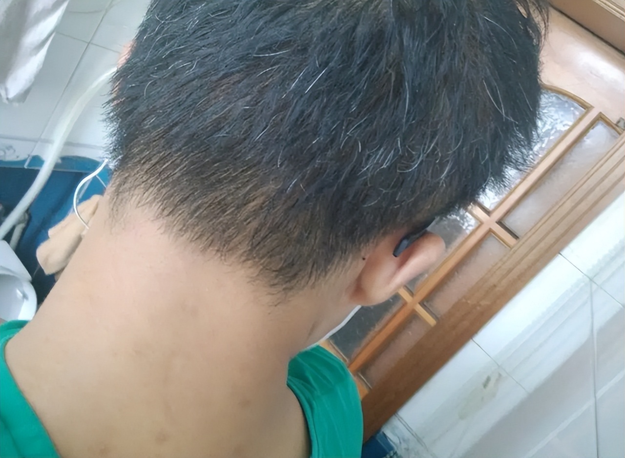 前额和后脑勺有白发,前额后脑勺长白发什么原因