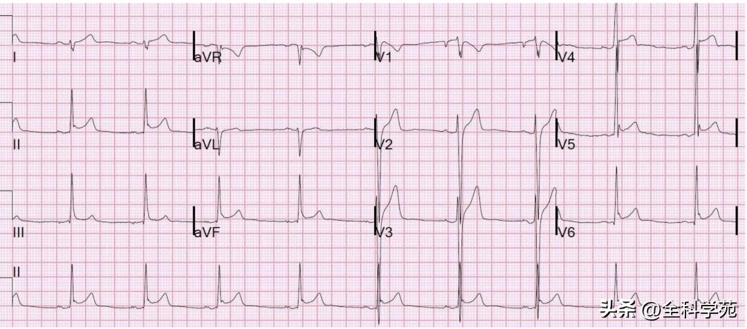 t波高尖心电图判断标准,t波高尖判断标准