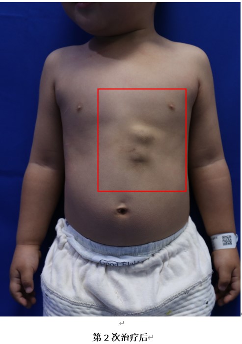 淋巴管瘤的微创治疗,淋巴管瘤微创介入手术第二天