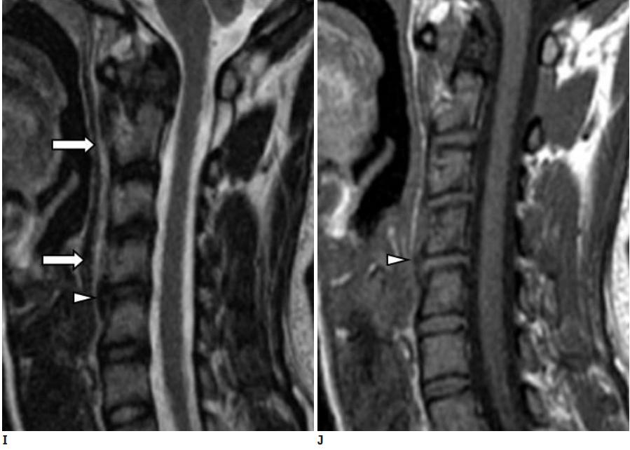 颈长肌腱炎影像表现,三头肌钙化性肌腱炎治疗