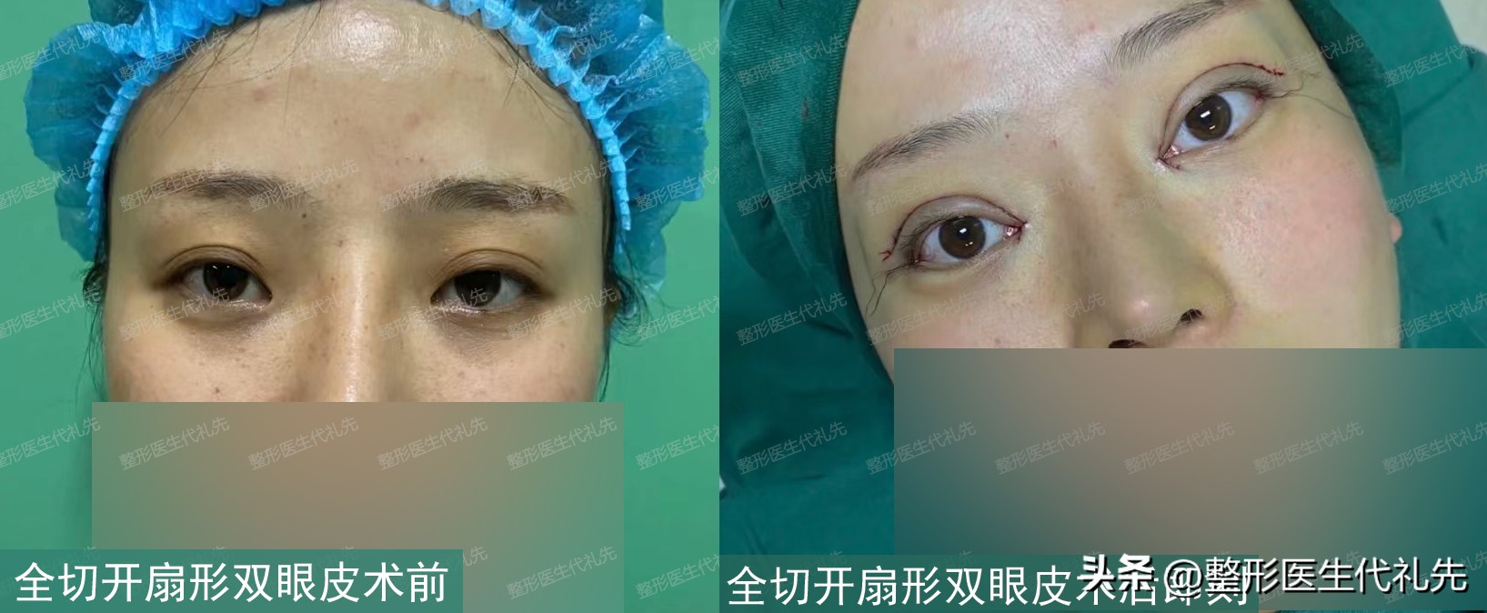 43岁女士全切开扇形双眼皮,术前术后高清照片细节对比,变化很大