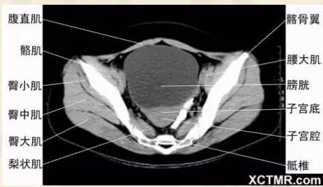 胸腹部盆腔ct主要检查什么,女性盆腔ct断层解剖结构图