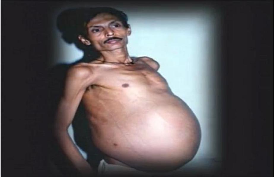 印度女子产下罕见胎中胎,胎中胎真实案例印度