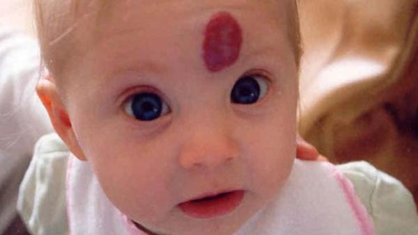 小孩身上的红痣可能是血管瘤,幼儿身上小红点富贵痣竟是血管瘤