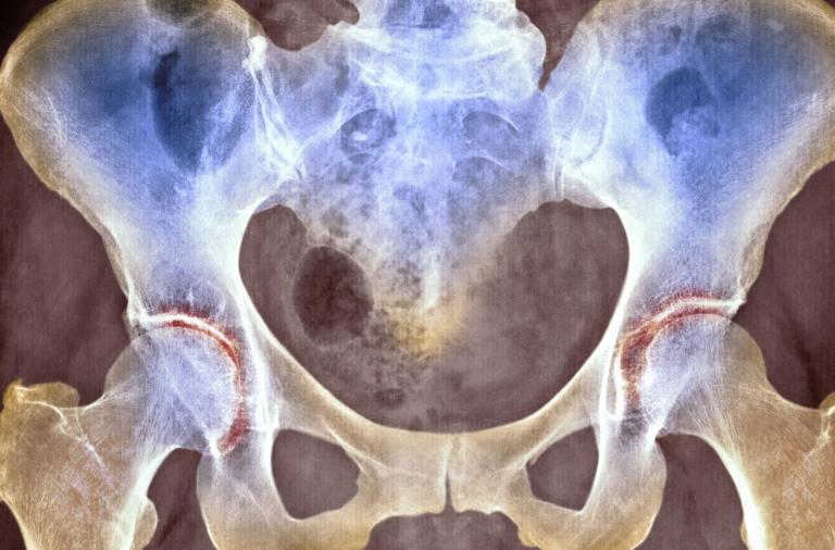 胯骨疼是什么原因造成的,胯骨疼是什么原因引起来的