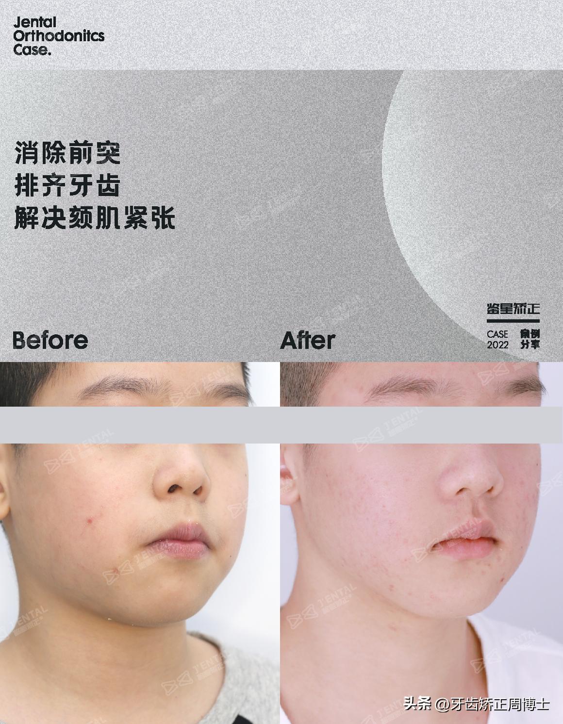 mrc戴上后不能闭上嘴怎么办,mrc矫正能用到几岁