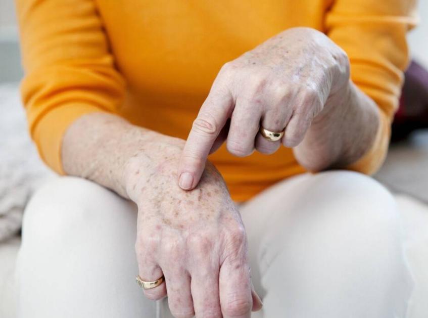 老年斑用红霉素软膏可以除掉吗,用红霉素眼药膏去除老年斑有效吗