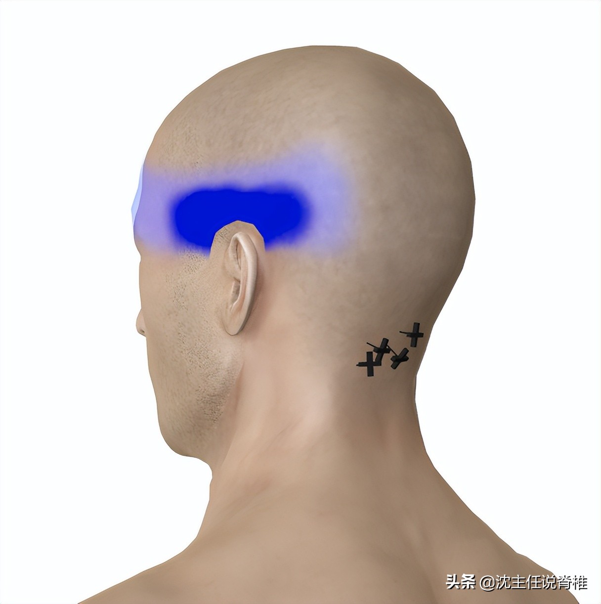 太阳穴疼痛警惕四种病,太阳穴周围疼痛是什么病的预兆