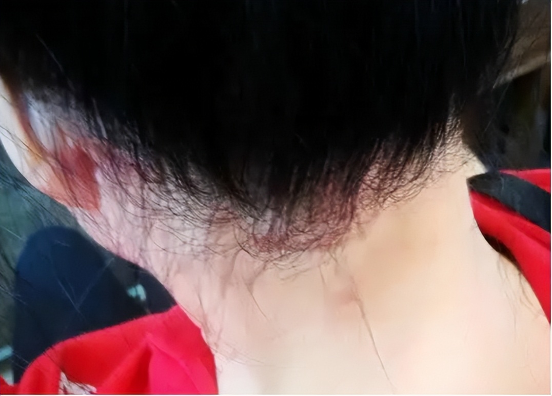 头皮上摸到一个硬疙瘩,头皮有小疙瘩摸着疼怎么回事