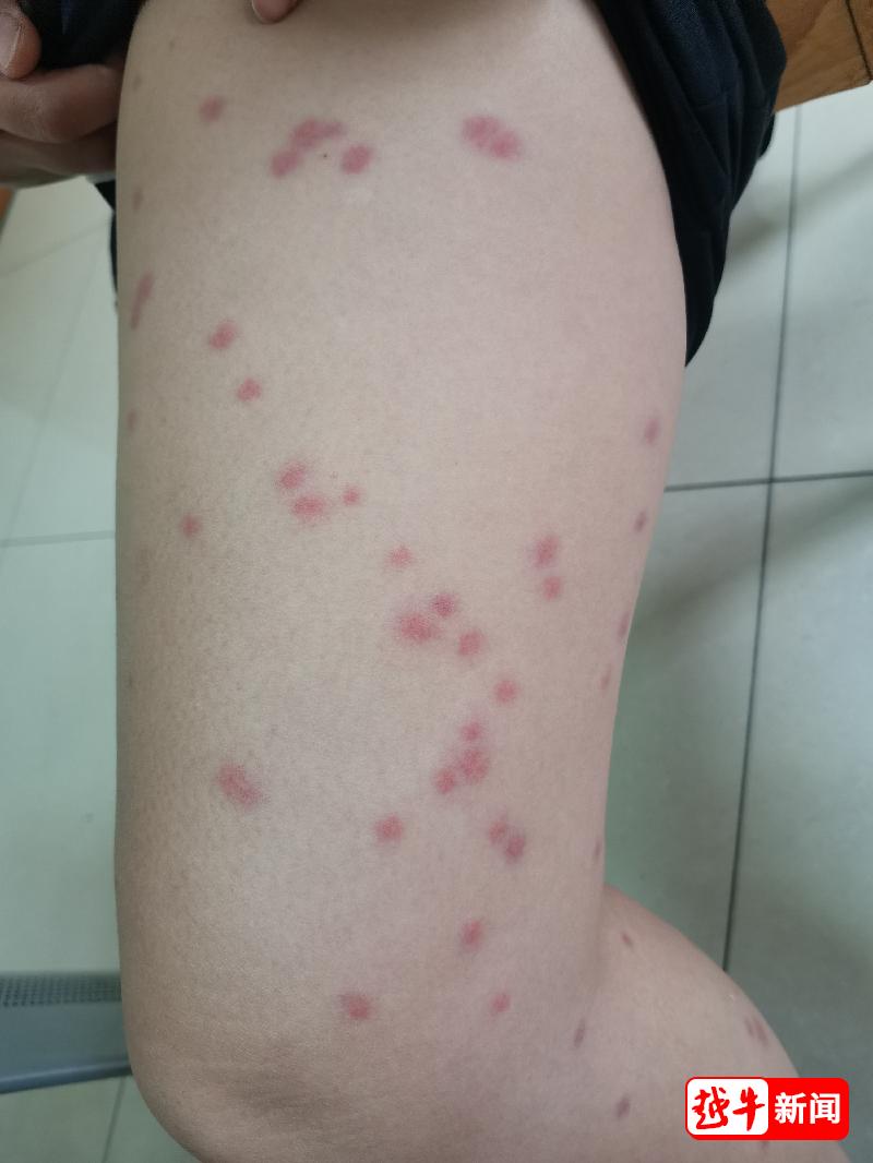 小孩儿最近身上出疙瘩是梅毒吗,最近儿童身上起小红疙瘩特别痒