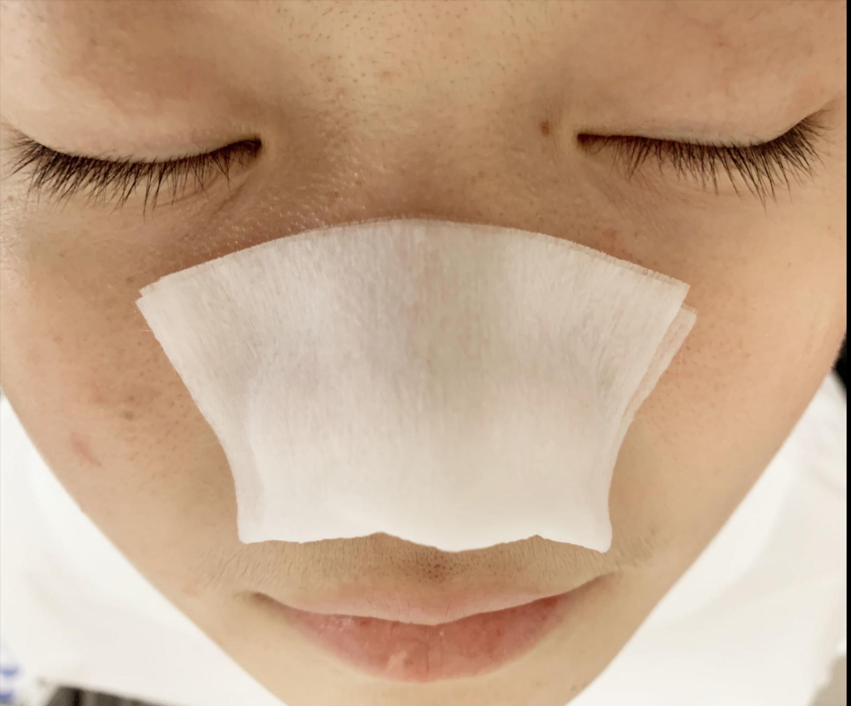 鼻子毛孔小黑头出不来怎么办,小女孩鼻子有黑头毛孔粗怎么办