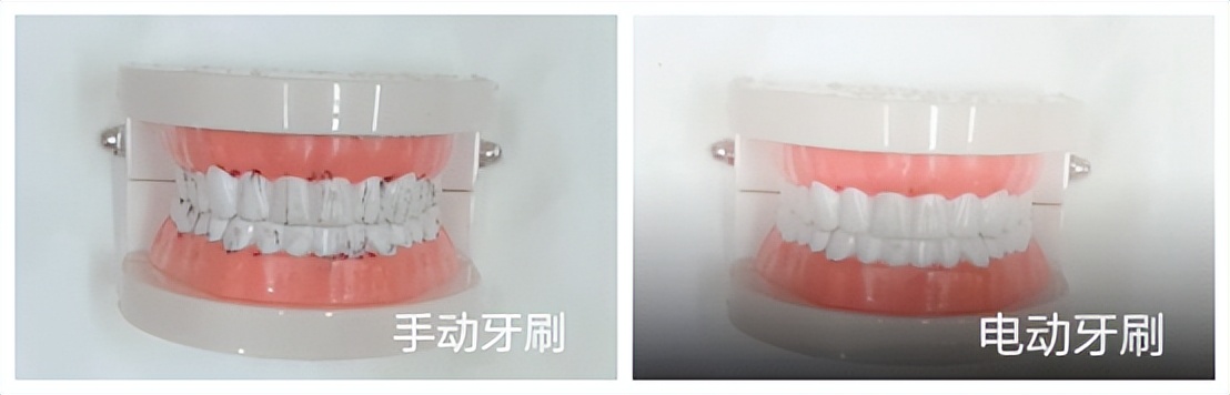 电动牙刷的好处与弊端,电动牙刷刷牙的弊端