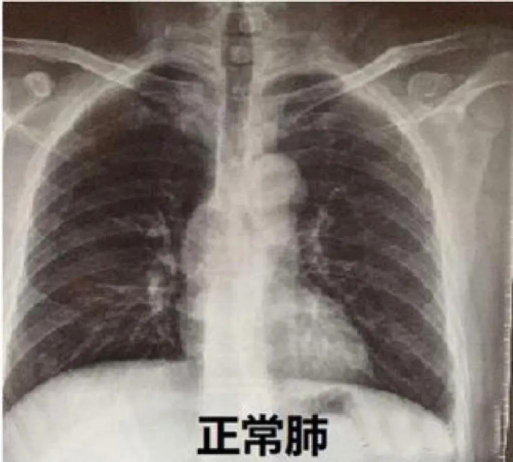 武汉女子咳嗽,7岁女孩咳嗽严重被查出白肺