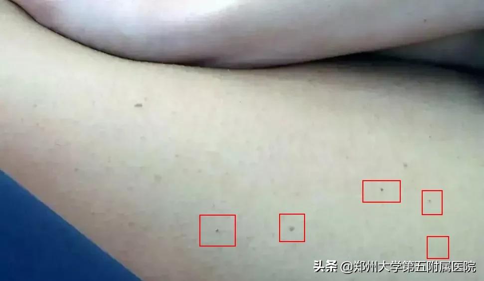 激光祛痣祛得彻底吗,激光祛痣法真的有用吗