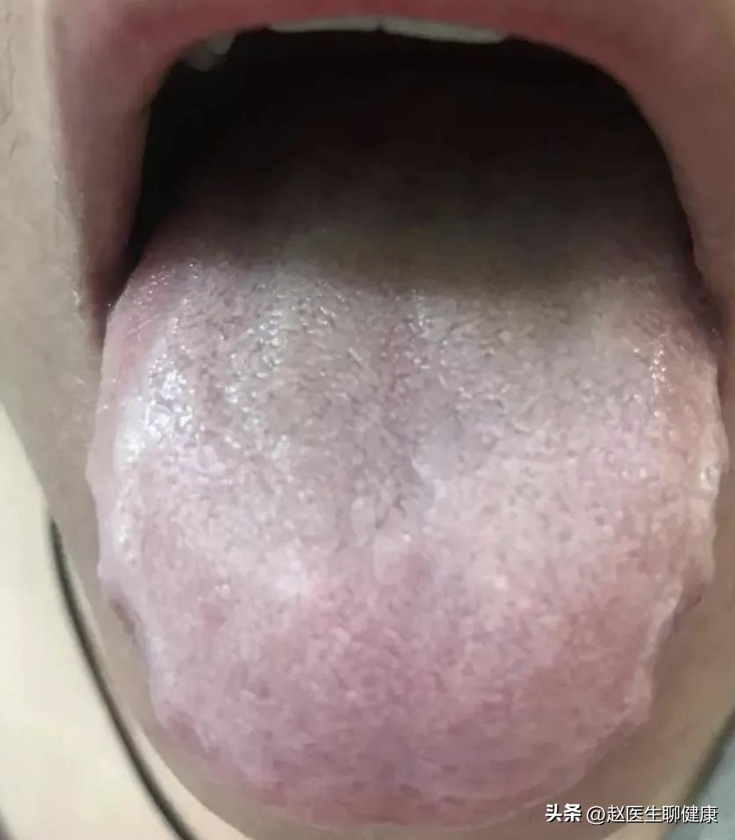 寒湿大便不成形粘马桶吃什么调理,大便粘腻粘马桶不成形中药调理