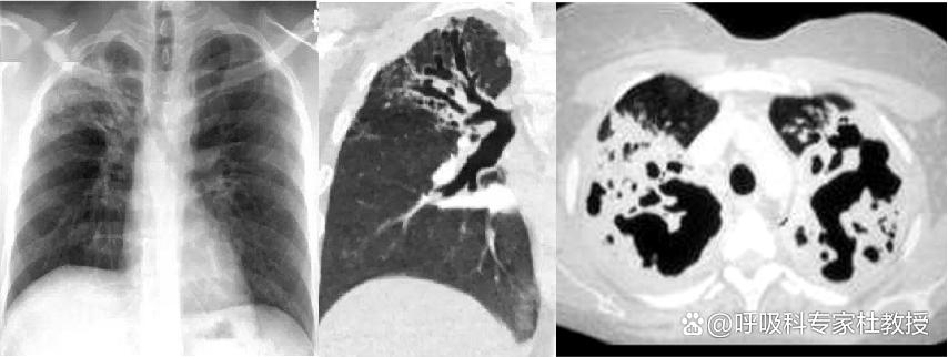 1分钟教你看懂ct报告单,一分钟自测支气管炎