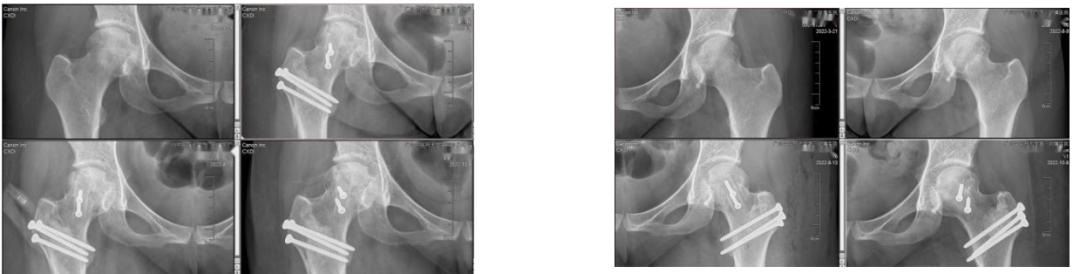 冲击波治疗股骨头坏死后拄拐吗,股骨头坏死钻孔减压要拄拐多久