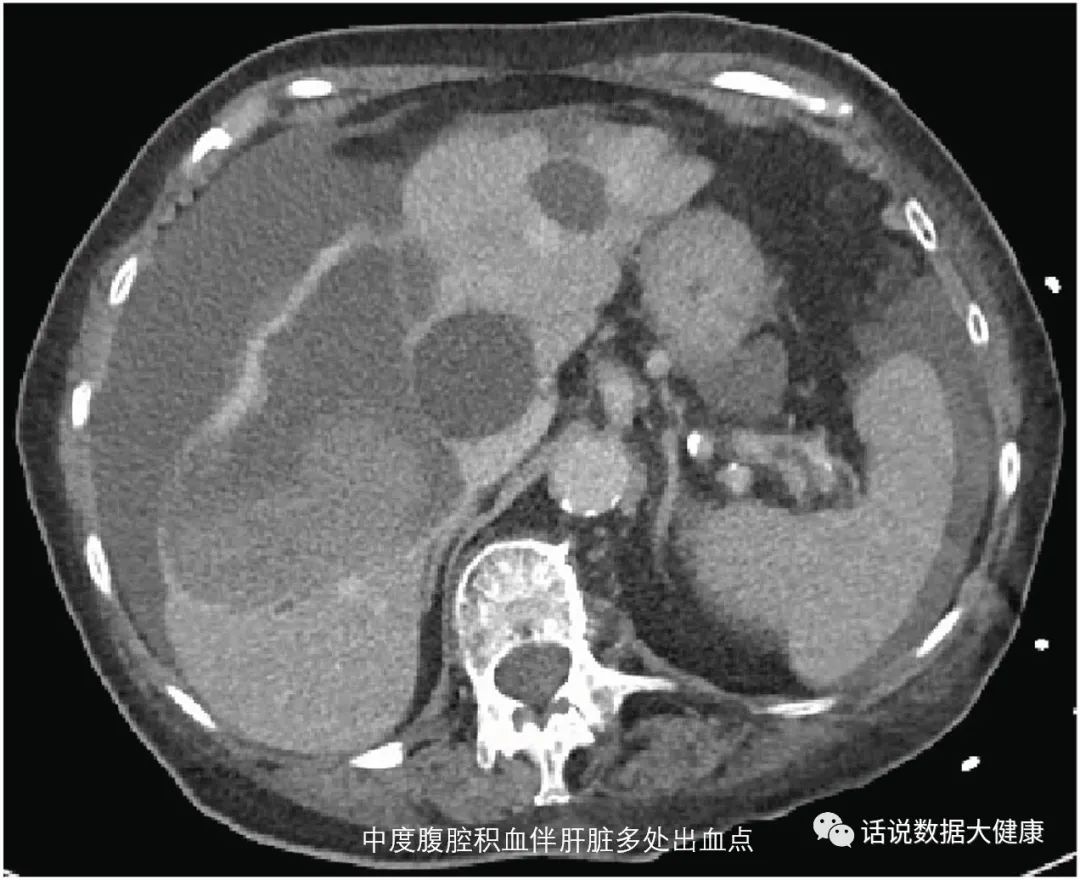 纳豆能预防心脑血管病吗,纳豆胶囊对于心血管狭窄有效吗