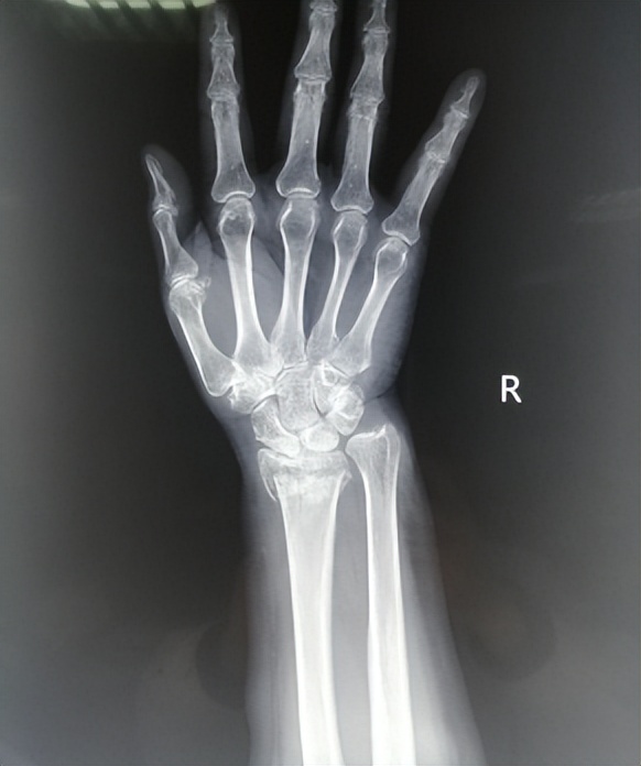 桡骨远端骨折的护理方法,手腕桡骨远端骨折后的恢复过程